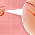 Early warning signs of ovarian cancer