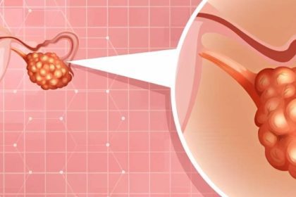 Early warning signs of ovarian cancer