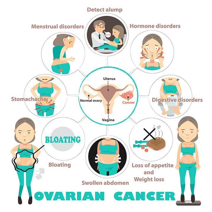 Symptoms of ovarian cancers: